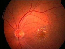 红细胞增多症眼底病变