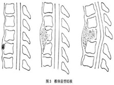 单纯性脊柱结核