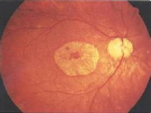 回旋状脉络膜视网膜萎缩
