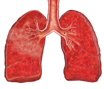 支气管肺发育不良