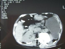 小儿先天性肾盂输尿管连接部梗阻