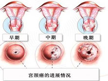 妊娠合并宫颈癌