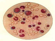 小儿先天性红细胞生成异常性贫血
