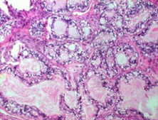 卵巢小细胞癌