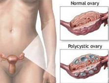 卵巢功能异常综合征