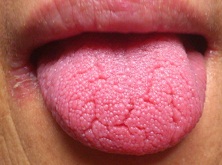 裂沟舌