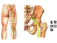 坐骨神经痛