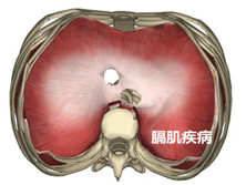 膈肌疾病