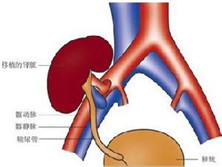 肾静脉血栓