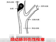 颈动脉创伤性栓塞