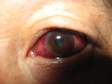 视网膜静脉周围炎