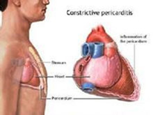 急性腹型-高脂血症综合征