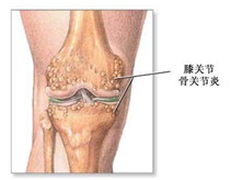 老年骨关节炎