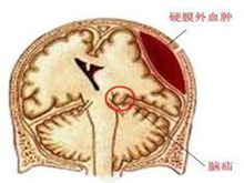 耳内脑膜脑疝