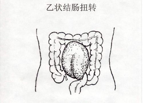 结肠扭转