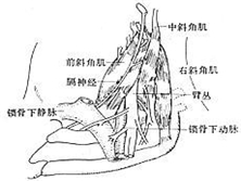 上干型胸廓出口综合征