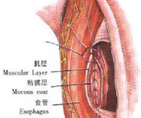 弥漫性食管壁内憩室
