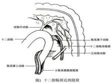 十二指肠旁疝