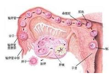 多囊卵巢综合症
