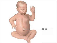 婴幼儿脐疝