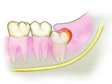 智齿冠周炎