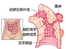 克罗恩病