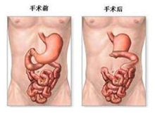 急性肠胃炎