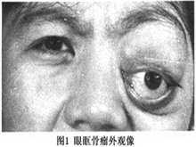 眼眶骨瘤
