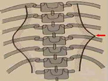 脊椎结核寒性脓肿穿入空腔脏器