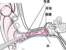 慢性外耳道炎