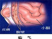 腹股沟直疝（疝气）