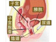 子宫下垂