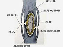 胸壁骨肿瘤