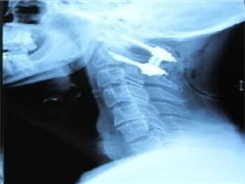 伴齿状突骨折的寰枢椎前脱位