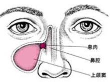 慢性额窦炎
