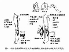 肌病肾病性代谢综合征