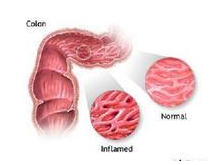 慢性结肠炎