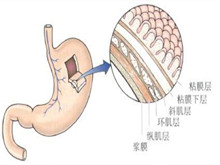 先天性胃壁肌层缺损