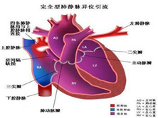 部分型肺静脉异位引流