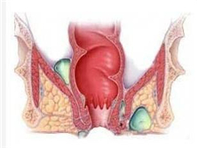 肛门直肠周围脓肿