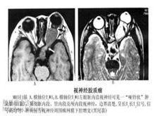 小儿视神经胶质瘤