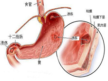 胃、十二指肠溃疡急性穿孔
