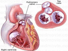 三尖瓣关闭不全