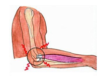 肱骨外上髁炎