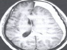 慢性硬脑膜下血肿