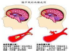 出血性脑中风