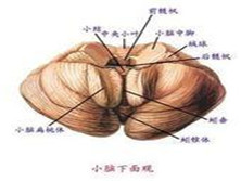 迟发性倾倒综合征