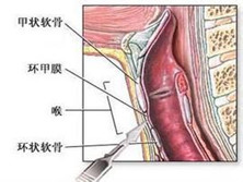 先天性喉裂