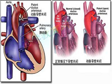 先天性动脉导管未闭
