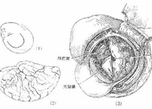 颅内肿瘤伴发的精神障碍